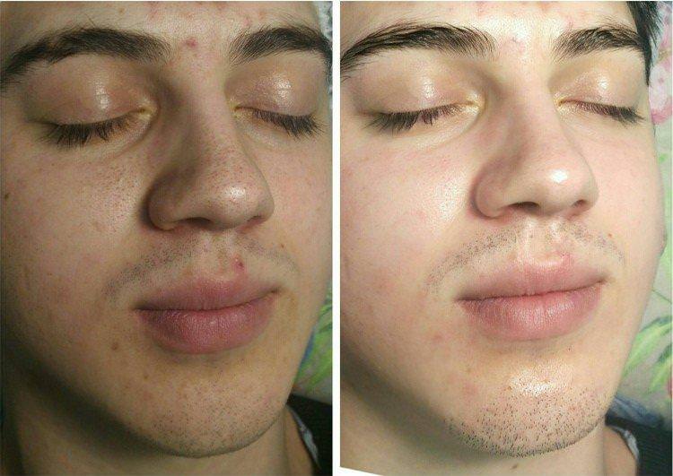 Ультразвукове чищення обличчя - фото до та після