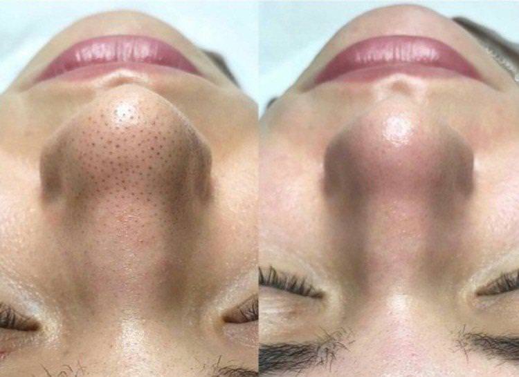 Ультразвукове чищення обличчя - фото до і після