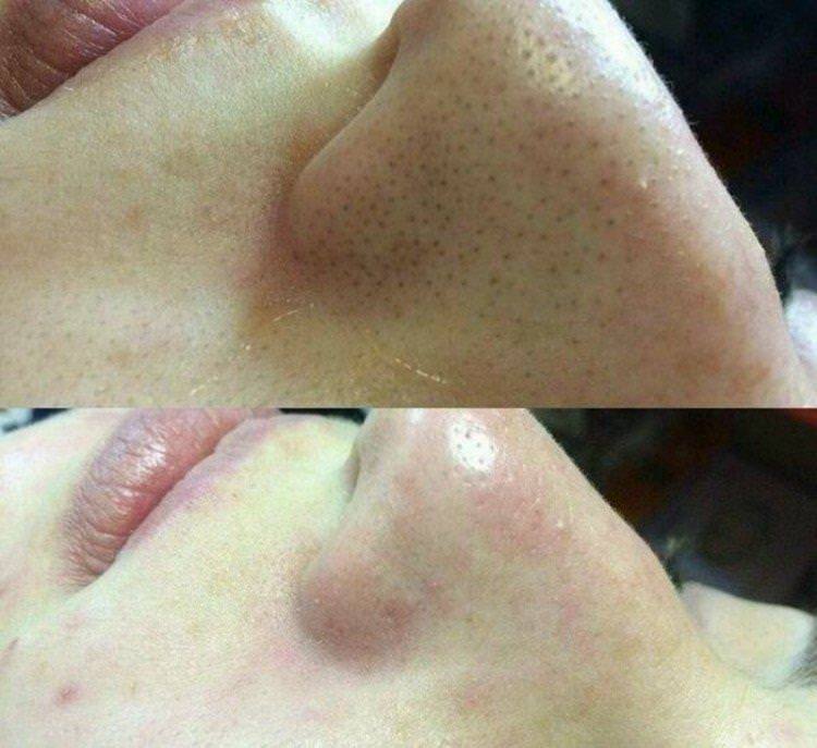 Ультразвукове чищення обличчя - фото до та після