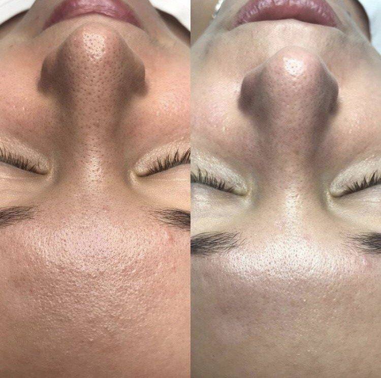 Ультразвукове чищення обличчя - фото до і після